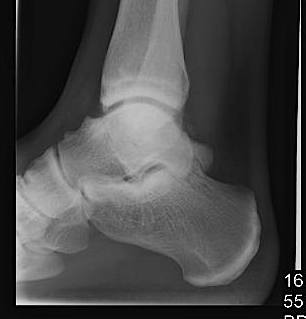 Ankle Spurs with Anterior Impingement